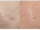 クリニカルスイート エーアール(Clinical sweet.ar)の写真/ファンデーションが落ち込む毛穴に、もう悩まない。頬のたるみ毛穴を集中ケア。
