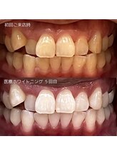 サロン ハナ(salon 87)/セルフホワイトニング