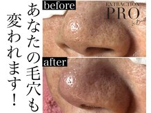 人気の毛穴エクストラクションプロで毛穴な黒ずみ除去！