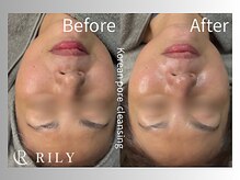 リリー(RILY)/【プラズマビフォーアフター】