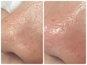 カピリナ(ka pilina)/～ツルツル肌へ毛穴洗浄～