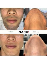 ナークス(NARX)/【ヒゲ脱毛】ビフォーアフター