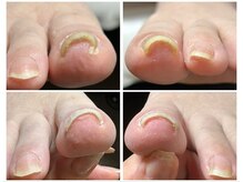 ラ グラース(La.Grace)/巻爪矯正ジェル　ヘイスイッチ