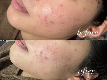 フェイン 青山店(fein.)/ニキビケアにも◎