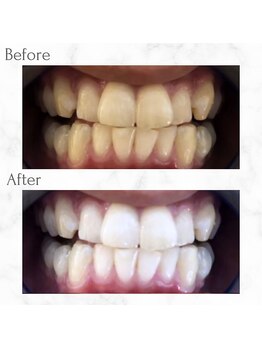 エクシアホワイトニング 天神店/ホワイトニングビフォーアフター