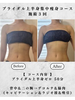 シーフェイス 横浜店(SEE FACE)/ブライダルデコルテ脇肉はみ肉