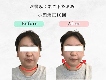 美容整体ウェリナ あま甚目寺院/.【小顔矯正before→after】