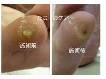 ドクターネイル爪革命 江戸川橋店/小指にできると靴を履くとき・・