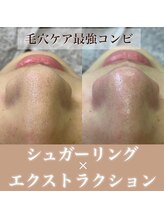 ギューテ(Gute)/毛穴エクストラクション