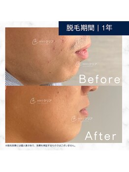 メンズクリア シーモール下関店/【メンズクリア】お客様の施術例