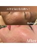 【ニキビ気になる跡へアプローチ！】お肌の土台から改善！凹凸ケアコース 