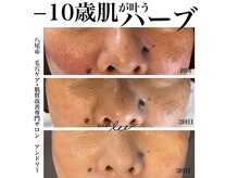 アンド リー(and lee)の雰囲気（ブラックハーブで即エイジングケア《たるみ・しわ・法令線改善》）
