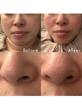 サロン ド モミカル(salon de momikaru)/毛穴洗浄