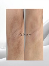 アンフィア(Anfia)/ローマピンク：脇の黒ずみケア