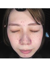 テセラ(Tethere)/ニキビケア