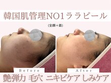 Cスキンケアクリニック 麻布店/ララピールBeforeAfter#ハリつや