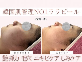 Cスキンケアクリニック 麻布店/ララピールBeforeAfter#ハリつや