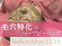 ベアール(beal)/毛穴の根本改善ハーブピーリング