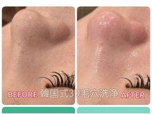 シキ(SIKI)/＼効果絶大／韓国式3Ｄ毛穴洗浄