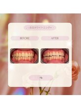 プラスビーセルフ(+b self)/ホワイトニングビフォーアフター