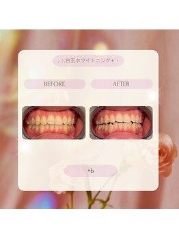 プラスビーセルフ(+b self)/ホワイトニングビフォーアフター
