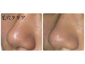 カレン 天神本店の写真/全顔毛穴クリア