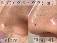 マシェリ(macherie)/話題の毛穴エクストラクション!