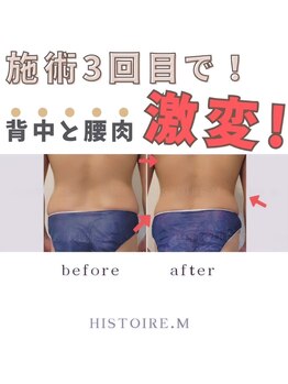 イストアールエム(HISTOIRE.M)/筋膜リリースダイエットコース