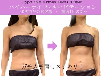 シャルム(charme)/スマホ首にハイパーナイフ