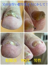 巻き爪じゅん 千葉駅前店/父の分厚い肥厚爪どうにかして！