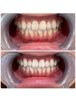 エクシアホワイトニング 日本橋店/ブライダルホワイトニング