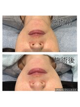 レイモード(Ray mode)/BBLフェイシャルトリートメント