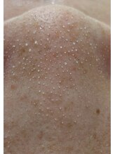 ビューティフィーサロン ベルル(Belulu)/毛穴洗浄／スチームパック後