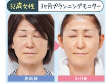 花銀クラブ(花銀Club)/ダーマペンのダウンタイム無し版