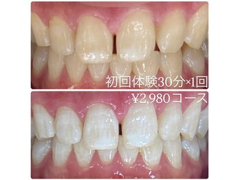 ホワイトニングルーム 横浜店(Whitening Room)/ホワイトニング/横浜