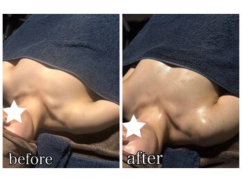 リルマコ/バスト症例写真