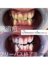 ホワイトニングサロン 京都烏丸店/ホワイトニング施術例