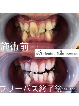 ホワイトニングサロン 京都烏丸店/ホワイトニング施術例