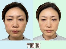 ナチュラルパーフェクトフェイス 新宿/7回目／目の左右差改善/新宿小顔