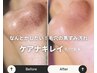 【学割U24】毛穴スッキリ♪毛穴洗浄+パック