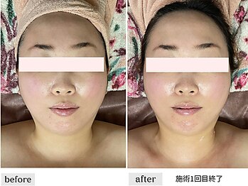 ペルク(perk)/小顔コルギ70分