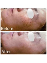 ブランシェ 野々市店 × 椿/シミケア　お客様