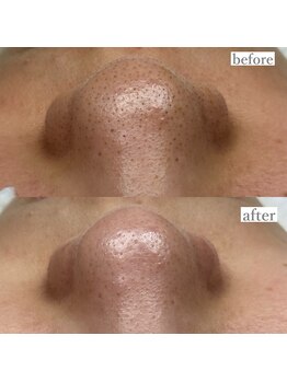 ライカブルー(RaicA BluE)/施術写真　before-after