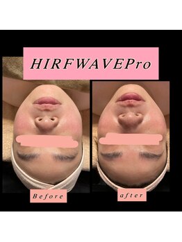 ティアメディカル(Tia Medical)/HIRFWAVEPro