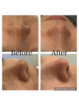 トウキョウビューティーラボ(TOKYO BEAUTY LABO.)/Before&After(ハイドラ)