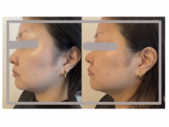 ソラ(sola*)/レモンボトル