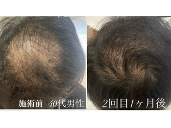 テテメルティ(te-te melty)/プロセル頭皮トリートメント