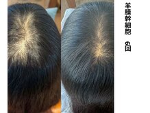 ボニータ(Bonita)/【頭皮Lit】ヒト羊膜幹細胞