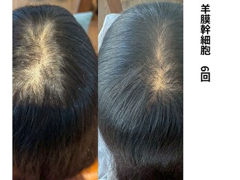 ボニータ(Bonita)/【頭皮Lit】ヒト羊膜幹細胞