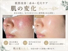アンジェ(ange)の雰囲気（【肌荒れ/ニキビケア/ハーブピーリング/毛穴/毛穴/乾燥/赤み】）